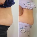 굿바디핏 | [부전동]부산서면피부과 복부 바디핏주사 후기