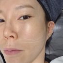 자방모드 | 강남피부과 강남역 인모드 찐 후기