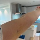 꼬멜 | [임플라논 제거 후기] (사진포함)임플라논 제거 후기, 비용/임플라논 부작용 부정출혈 2년 후기