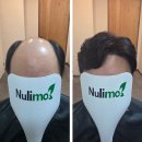 누리약품 | [구미가발 전문점] 누리모의 50대 고객님의 자신감 회복 | 테잎식 가발로 새롭게 시작하다”