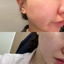 셀스테틱 부산서면점 | 부산서면피부과 흉터 개선 모공 탄력 개선 블랙라벨 셀엑소좀 후기