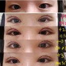 더페이스성형외과의원 | 부산 서면 더페이스 성형외과 쌍꺼풀 수술 후기(초기, 후기 사진 有)