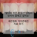 레진침투 아이콘레진으로 치아에 하얀반점(반점치) 치료 후기 ㅣ 평택 치과