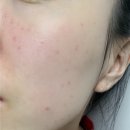 31140-9-16-2 | 편평사마귀 제거 후기 7-16일차 | 2주차 흉터 색소침착 붉은기, 쓰던 화장품 계속 써도 될까?