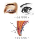 리매몰