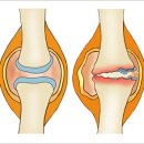 무릎 퇴행성 관절염 제대혈 줄기세포(카티스템) 치료 이미지