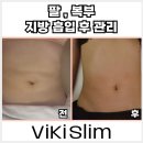 강남 지방흡입 후 팔/복부 라인 완성 관리 [비키슬림 앤 바디 강남점]