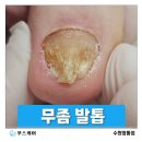 수원행복한요양병원 | 수원 영통 당뇨무좀, 어르신 당뇨발톱 2회차 관리후기