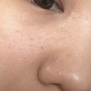 광은 | 30대 모공·속건조 고민에 리쥬란 더마힐러 포어패드 써본 솔직 후기 (광은 생기고 들뜸은 사라짐)