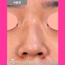 비개방 복코교정 전후사진으로 알아보는 외모 고민 변화과정