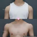 직각어깨필러, 승모근보톡스만으로는 부족한 이유 | 바이미성형외과