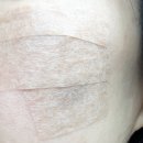 라움성형외과의원 | 압구정 라움성형외과 흑자치료 기록#2 듀오덤 제거 후 경과