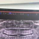 상하치과의원 | [정보] 사랑니 2개 발치한 후기 (단순매복)