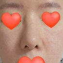 이나코 | 수술 20일 차 코재수술 후기｜부목 제거 후 괜찮았는데 콧대가 휘어 보이는 이유? 붓기일까?