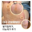 티눈제거 발각질제거 후기 : 라보떼뷰티 (대봉동네일 가게)