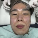피니프 | 강남 피니프리프팅 포텐자 피부과 비수술 얼굴 리프팅 예비신부 결혼