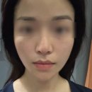 한국지엠논현서비스 | 논현역 피부과 키닥터 온다리프팅 6만줄 가격 / 후기 [턱선&amp;팔자주름 개선]