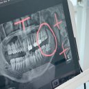동강제일약국 | 사랑이 아프니 매복 사랑니 탈출기 2
