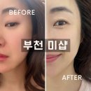 양지할인마트 | 부천 미샵 하이푸리프팅 | 옥길동피부관리 찐후기