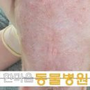 전염성 강한 피부병 옴 진드기 증상 가려움증 예방 이미지