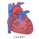 오래된 심근경색증 이미지