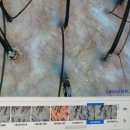 웰킨(의정부점) | 의정부탈모관리 웰킨 두피탈모센터 의정부점 두피 스케일링 후기