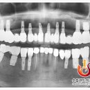 수플란트 이미지