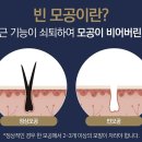 동의본한의원 | [안산/시흥탈모병원] "후기까지 진행된 남성형탈모, 정말 회복이 가능할까요?"