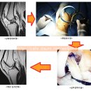 어깨회전근개파열과 전방십자인대파열은 관절내시경 치료!! 이미지
