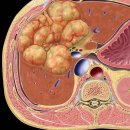 담즙 낭선암종(Biliary Cystadenocarcinoma) 이미지