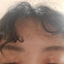 서울올업피부과의원 네이버블로그