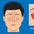 비중격 만곡증[deviated nasal septum] 이미지