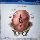 약 놀람주의) 공부중인데 이거 존나무섭지않냐 재왕절개 할때 자궁파열 그림;; 이미지