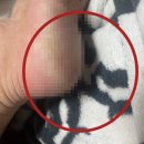 세린한의원 | 발뒤꿈치양말 착용 전 필독!(+발꿈치 각질제거)