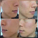 죽전역 | 대구피코프락셀 내돈내산 7일 후기｜죽전역피부과 모공·여드름흉터 효과 통증