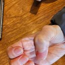 레푸스 방이역점 | 물어뜯고 뜯어내던 손톱, 조갑박리처럼 다 들뜨고 노래졌던 손톱이 레푸스 덕분에 다시 자라났어요.