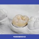 주안치과기공소 네이버블로그