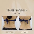 스마일 피부/미용/체형 교정 클리닉 | 양재동 다이어트 러브핸들 군살 고민, 스테로이드 없는 엑스주사 4회 전후사진