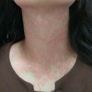 나 옛날에 원인불명 두드러기 앓았을때 ㅋㅋㅋㅋ (혐주의) 이미지