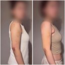 분당부자 | 분당 팔뚝람스후기 솔직 후기 가격, 붓기, 통증 변화 총정리