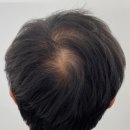 더블라인 | 밝은 조명 아래 신경 쓰이던 정수리 구미 더블라인스칼프 후기
