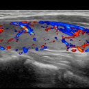 Diffuse enlarged heterogeneous echotexture &amp; hypervascularity 이미지