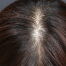 현's hair(현스헤어) | 군포탈모병원 후기, 모발이식 고민하다 탈모치료 선택한 이유