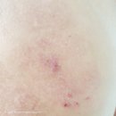 피부가려움증 아토피로션 : 피엘메드 아토컴플렉스엔 (아토피안 사용후기)