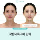 고운얼굴 | 대구피부관리 원탑 찍은 고운빛깔에스테틱 대구점 비대칭+큰 얼굴 고민 해결하고 온 찐 후기