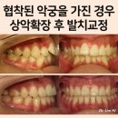 궁치과병원 | 상악궁이 좁을 때, 골격성 상악확장 후 발치교정 후기