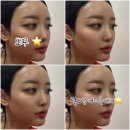 스타리치 | <오오티디> 여드름패치추천 올리브영여드름패치 뾰꾸템 오오티디스타스팟패치 사용후기 ෆෆ
