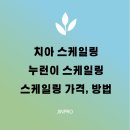 임성우내외치과의원 | 치석 제거 후 반드시 알아야 할 관리법 (+치아 건강 꿀팁 총정리)