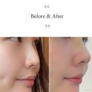 하이코코 | 강남역 하이코, 코실리프팅 받고 온 후기