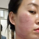 미아사거리역 | 미아사거리역 피부과 인모드리프팅 내돈내산 후기